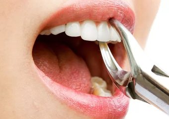 دلایل کشیدن دندان های آسیب دیده | بهترین دندانپزشک اصفهان