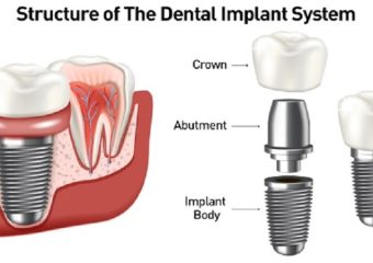 روش های مختلف ایمپلنت دندان | بهترین دندانپزشک اصفهان