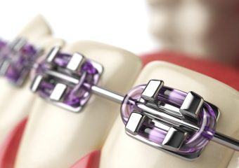 روش های کاهش طول درمان ارتودنسی دندان | بهترین دندانپزشک زیبایی اصفهان