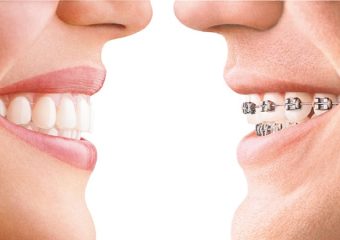 سن مناسب برای انجام ارتودنسی دندان | بهترین ایمپلنت اصفهان