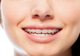 دلایل انجام ارتودنسی فک بالا | بهترین ایمپلنت اصفهان