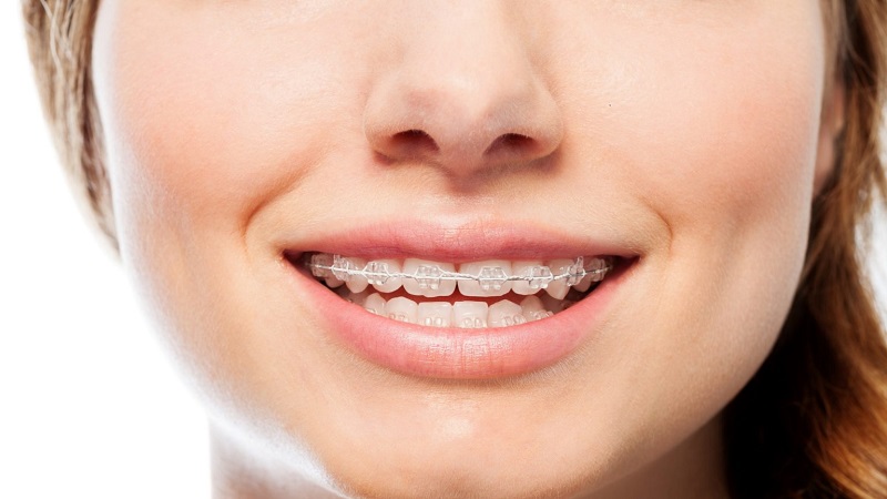 دلایل انجام ارتودنسی فک بالا | بهترین ایمپلنت اصفهان