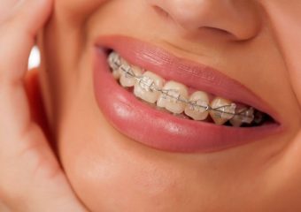 مقایسه انواع ارتودنسی دندان | بهترین ایمپلنت اصفهان