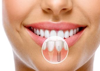 نکات مراقبتی قبل و بعد از ایمپلنت دندان | بهترین دندانپزشک زیبایی اصفهان