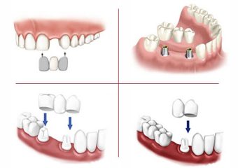 مزیت ها و معایب انواع بریج دندان | بهترین دندانپزشک اصفهان