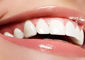 آنچه باید از بلیچینگ دندان بدانید | بهترین ایمپلنت اصفهان