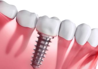 ایمپلنت فوری دندان | بهترین دندانپزشک اصفهان