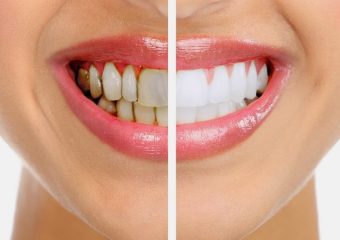 بررسی کامل جرمگیری دندان | بهترین دندانپزشک اصفهان