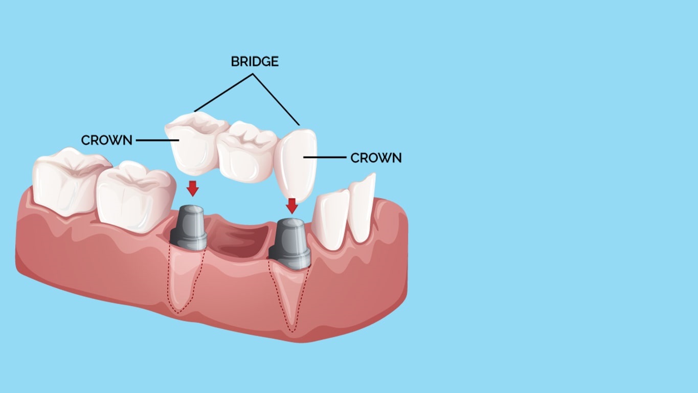 تفاوت بریج با ایمپلنت و روکش دندان | بهترین دندانپزشک اصفهان