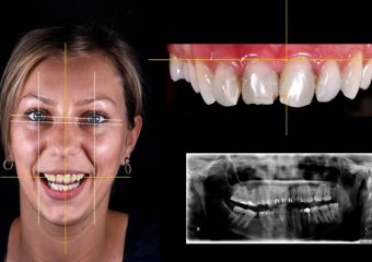 روش های اصلاح طرح لبخند | بهترین دندانپزشک زیبایی اصفهان