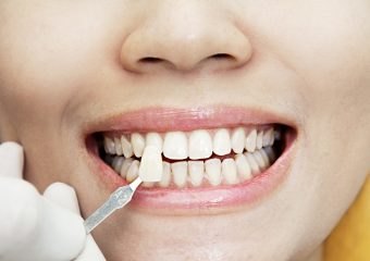 سن مناسب برای لمینت دندان | بهترین دندانپزشک زیبایی اصفهان