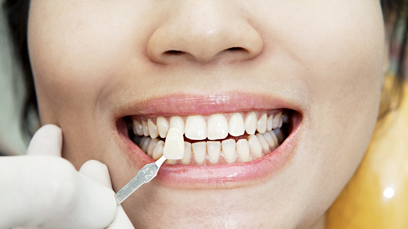 سن مناسب برای لمینت دندان | بهترین دندانپزشک زیبایی اصفهان