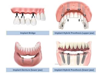 فواید و معایب انواع ایمپلنت | بهترین دندانپزشک اصفهان