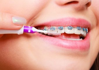 مراقبت از ارتودنسی در طول مدت درمان | بهترین دندانپزشک اصفهان