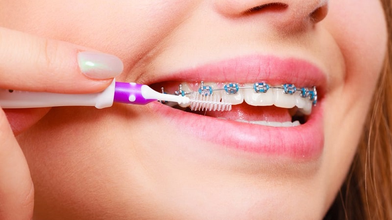 مراقبت از ارتودنسی در طول مدت درمان | بهترین دندانپزشک اصفهان