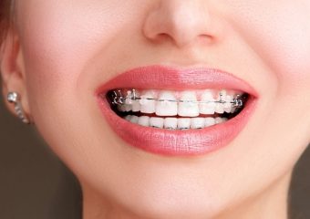مزایای ارتودنسی دیمون | بهترین دندانپزشک اصفهان