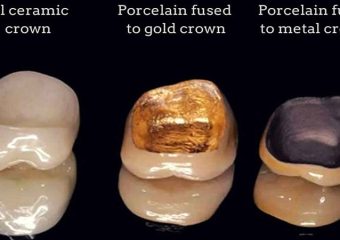 مقایسه تاج دندان موقت با دائمی | بهترین ایمپلنت اصفهان