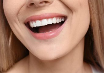 نکاتی برای قبل و بعد از لمینت دندان | بهترین دندانپزشک زیبایی اصفهان