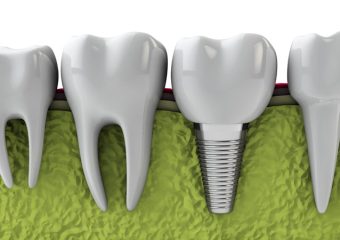 انواع ایمپلنت دندان | بهترین دندانپزشک اصفهان
