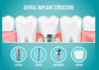 ایمپلنت دندان مناسب چه کسی نیست؟ | بهترین ایمپلنت اصفهان