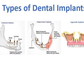 ایمپلنت ها بر اساس نوع جراحی | بهترین ایمپلنت اصفهان