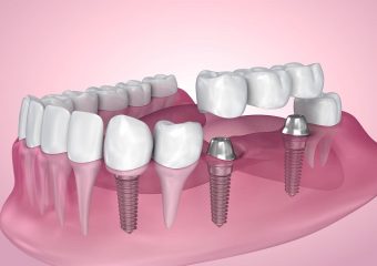 بهترین روش کاشت دندان | بهترین دندانپزشک زیبایی اصفهان