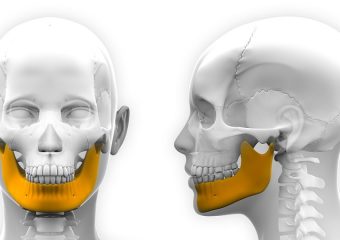 تکنیک‌های بازسازی استخوان فک | بهترین دندانپزشک اصفهان