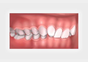 روند درمان دیپ بایت | بهترین دندانپزشک اصفهان