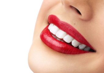 محبوبترین روش های دندانپزشکی سفید کردن دندان | بهترین دندانپزشک اصفهان