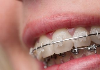 مراحل ارتودنسی دیمون چیست؟ | بهترین ایمپلنت اصفهان