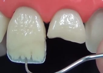 مقایسه کامپوزیت و لمینت دندان در تغییر رنگ و ظاهر | بهترین دندانپزشک اصفهان