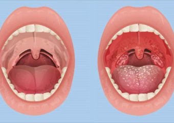 تشخیص علائم سنگ لوزه | بهترین دندانپزشک زیبایی اصفهان