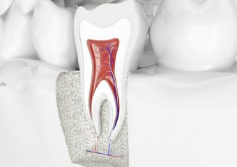 علل تغییر رنگ دندان بعد از عصب کشی | بهترین دندانپزشک اصفهان