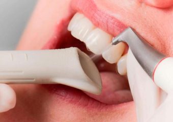 مراحل جرمگیری لثه | بهترین دندانپزشک اصفهان