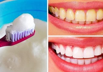 نحوه شستن و سفید کردن دندان مصنوعی | بهترین دندانپزشک زیبایی اصفهان