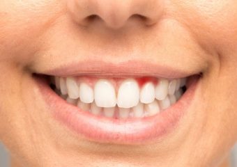 تشخیص علل انواع بیماری لثه | بهترین دندانپزشک اصفهان