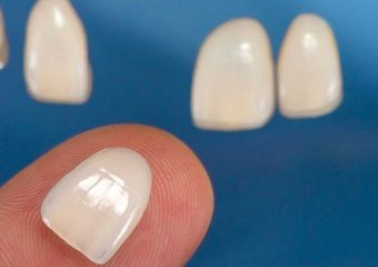 بررسی ضخامت لمینت دندان | بهترین ایمپلنت اصفهان