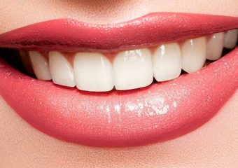 شرایط انجام برای لمینت دندان | بهترین دندانپزشک زیبایی اصفهان