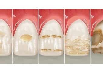 علل و نشانه فرسایش مینای دندان | بهترین دندانپزشک زیبایی اصفهان