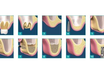 موارد مراقبتی پس از جراحی لیفت سینوس | بهترین دندانپزشک اصفهان