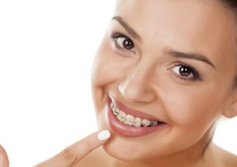 نکات مراقبتی در طول درمان ارتودنسی با براکت | بهترین دندانپزشک اصفهان