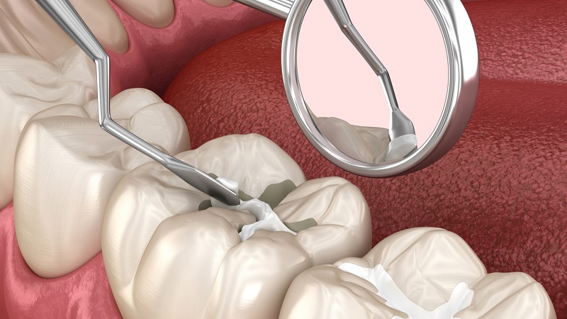 پیشگیری از پوسیدگی دندان با شیارپوش | بهترین ایمپلنت اصفهان