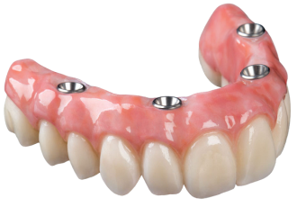 کاشت دندان مصنوعی چهار ایمپلنتی | بهترین دندانپزشک اصفهان