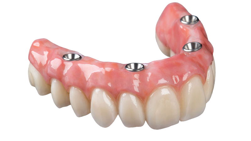کاشت دندان مصنوعی چهار ایمپلنتی | بهترین دندانپزشک اصفهان