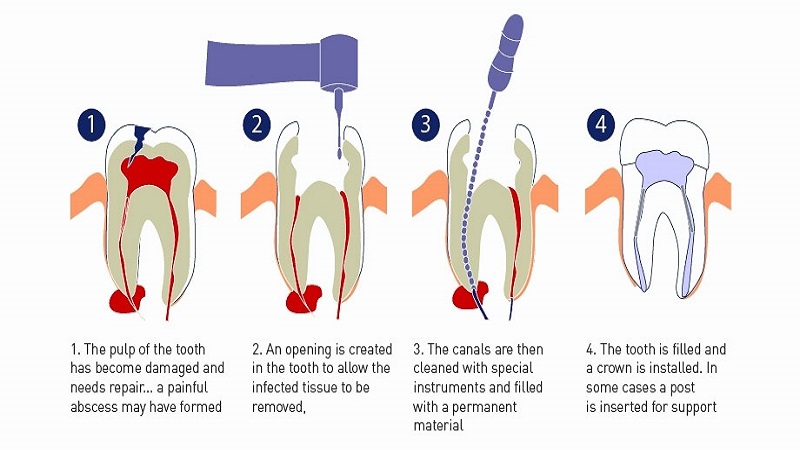 بررسی مراحل پر کردن دندان | بهترین دندانپزشک زیبایی اصفهان