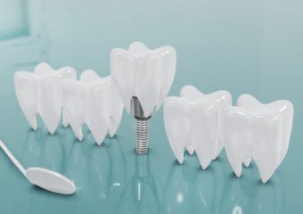 روش های جایگزینی دندان از دست رفته | بهترین ایمپلنت اصفهان