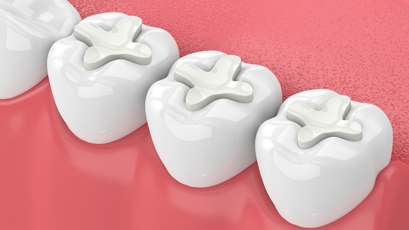 مزایا و معایب پر کردن دندان با طلا و آمالگام | بهترین دندانپزشک اصفهان