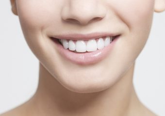 مقایسه انواع کامپوزیت دندان | بهترین ایمپلنت اصفهان