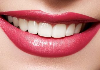 مقایسه لمینت کامپوزیتی با سرامیکی | بهترین دندانپزشک اصفهان