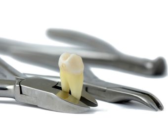 موارد نیاز به کشیدن دندان | بهترین دندانپزشک زیبایی اصفهان